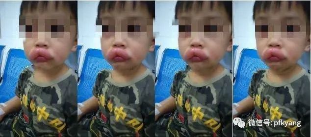 男孩吃葡萄過敏腫成嘟嘟嘴怎么回事？畫面詳情曝光網(wǎng)友忍不住笑了(圖2)