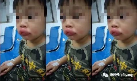 男孩吃葡萄過敏腫成嘟嘟嘴怎么回事？畫面詳情曝光網(wǎng)友忍不住笑了