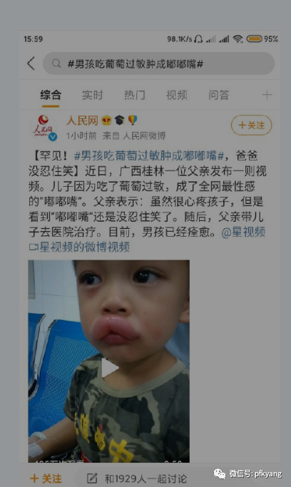 男孩吃葡萄過敏腫成嘟嘟嘴怎么回事？畫面詳情曝光網(wǎng)友忍不住笑了(圖3)