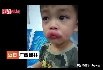 男孩吃葡萄過敏腫成嘟嘟嘴怎么回事？畫面詳情曝光網(wǎng)友忍不住笑了(圖5)